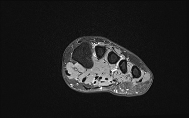 Bipartite hallux sesamoid diastasis (Radiopaedia 77133-89109 Coronal T2 fat sat 11).jpg