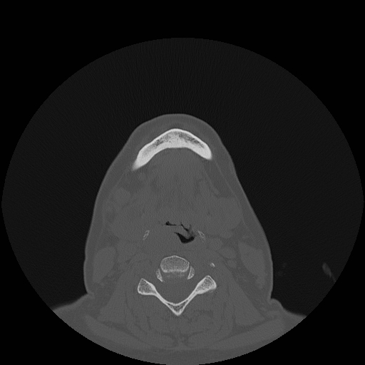 File:Bisphosphonate-related osteonecrosis of the jaw (Radiopaedia 71324-81642 Axial bone window 19).jpg