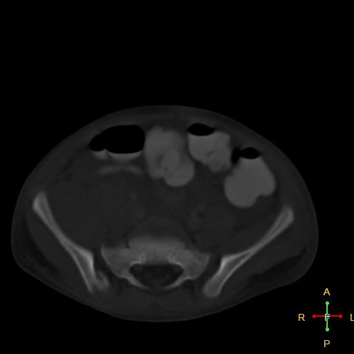 File:Blunt abdominal trauma (Radiopaedia 24780-25044 Axial bone window 7).jpg