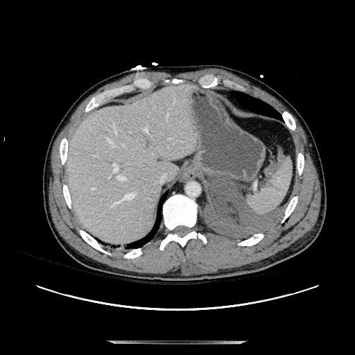Blunt abdominal trauma with solid organ and musculoskelatal injury with active extravasation (Radiopaedia 68364-77895 A 23).jpg