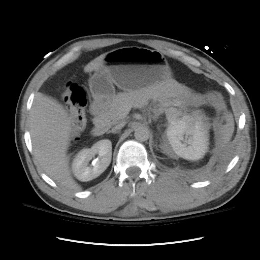 Blunt abdominal trauma with solid organ and musculoskelatal injury with active extravasation (Radiopaedia 68364-77895 Axial C+ delayed 43).jpg