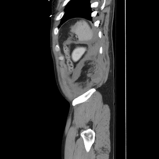 File:Blunt abdominal trauma with solid organ and musculoskelatal injury with active extravasation (Radiopaedia 68364-77895 C 124).jpg