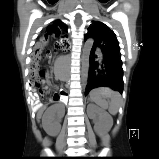 File:Bochdalek diaphragmatic hernia (Radiopaedia 38866-41059 Coronal liver window 15).jpg