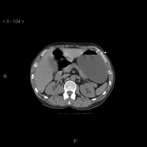 Boerhaave syndrome (Radiopaedia 27683-27897 Axial non-contrast 104).jpg