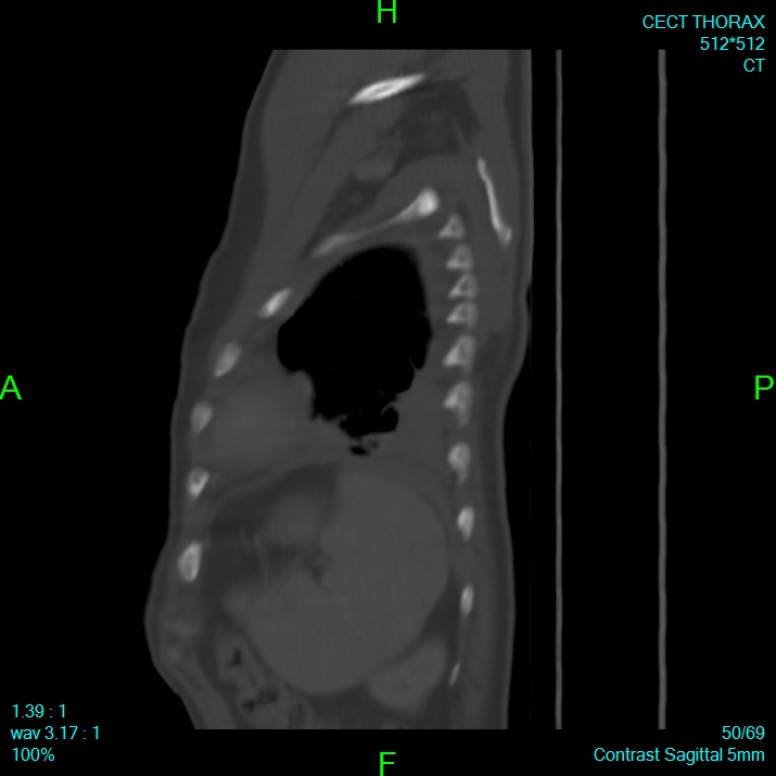 Bone metastases from lung carcinoma (Radiopaedia 54703-60937 Sagittal bone window 50).jpg