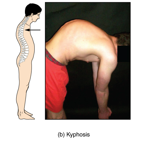 File:Bones and ligaments of the vertebral column (illustrations) (Radiopaedia 42770-45935 O 1).jpg