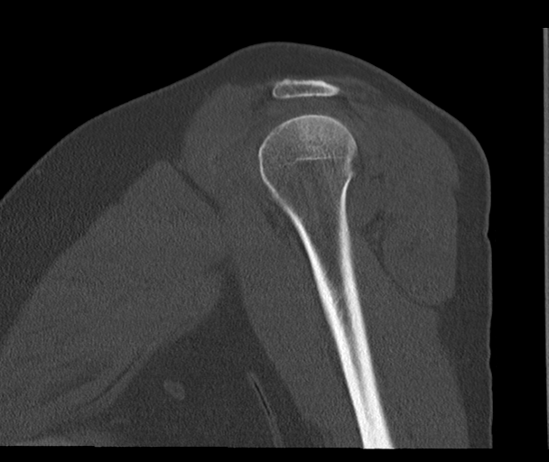 Bony Bankart and Hill-Sachs lesions (Radiopaedia 33622-34727 Sagittal bone window 22).png