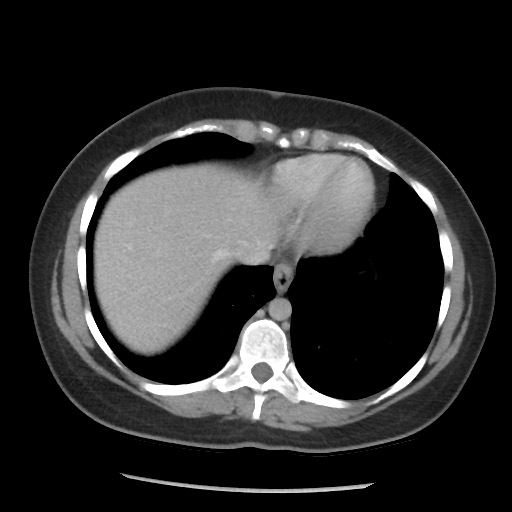 File:Borderline mucinous tumor (ovary) (Radiopaedia 78228-90808 A 64).jpg