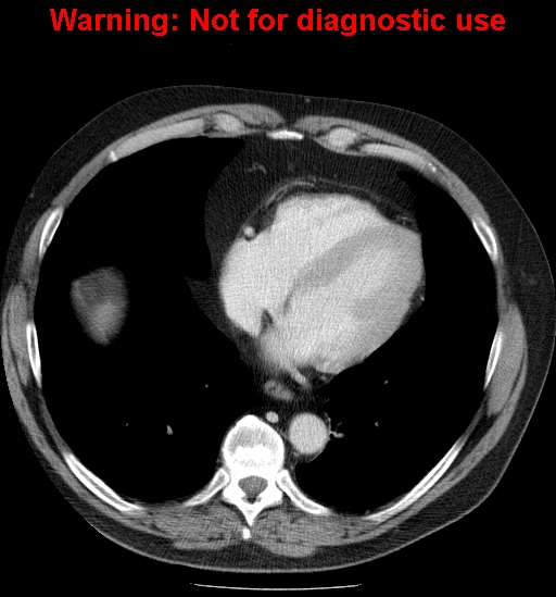 File:Bosniak renal cyst - type IV (Radiopaedia 23402-23466 D 1).jpg