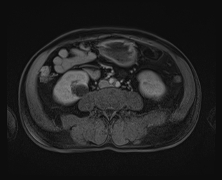 File:Bouveret syndrome (Radiopaedia 61017-68856 Axial T1 C+ fat sat 58).jpg