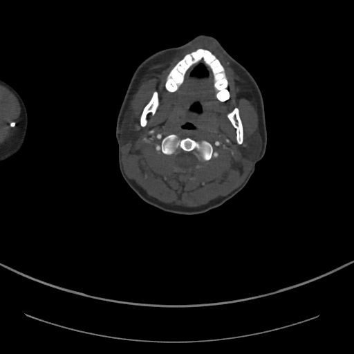 File:Brachiocephalic trunk pseudoaneurysm (Radiopaedia 70978-81191 Axial bone window 1).jpg