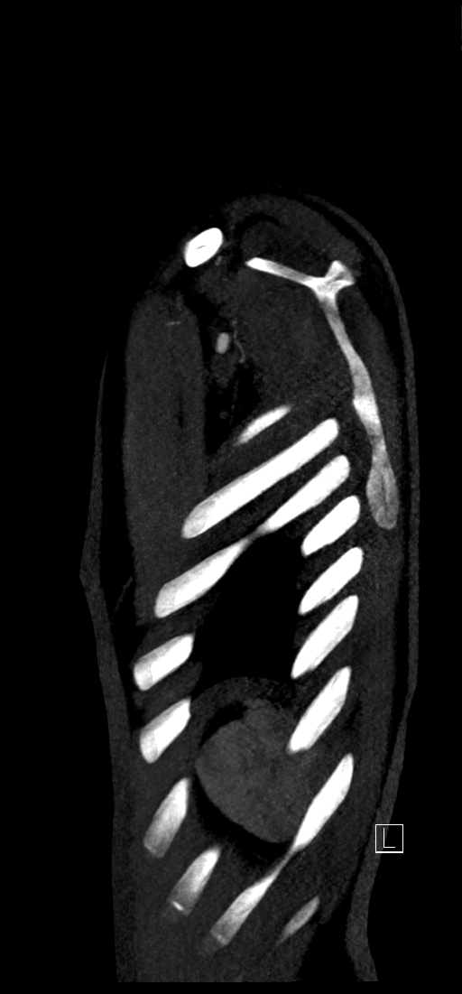 Brachiocephalic trunk pseudoaneurysm (Radiopaedia 70978-81191 C 87).jpg