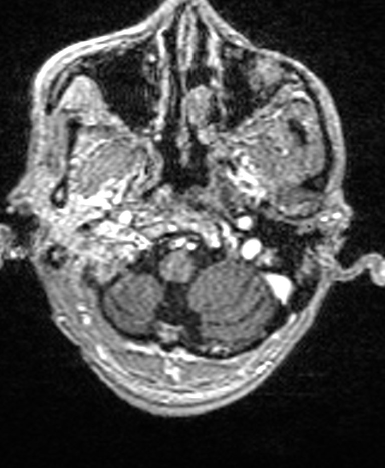 Brain abscess with dual rim sign (Radiopaedia 87566-103938 Axial T1 C+ 28).jpg