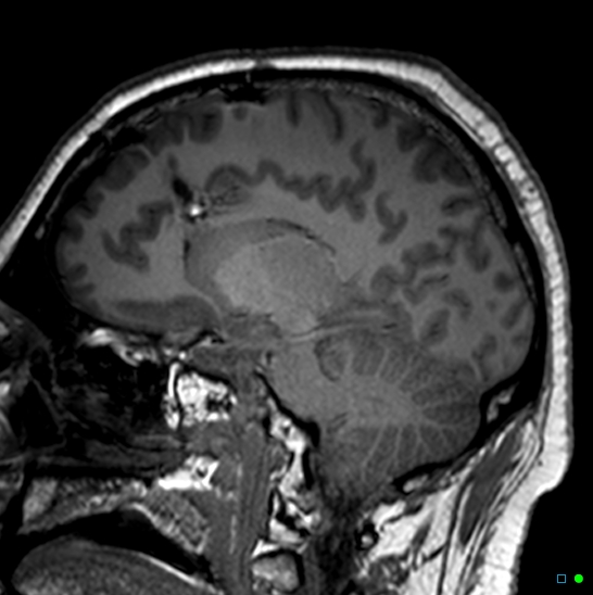 File:Brain death on MRI and CT angiography (Radiopaedia 42560-45689 Sagittal T1 37).jpg
