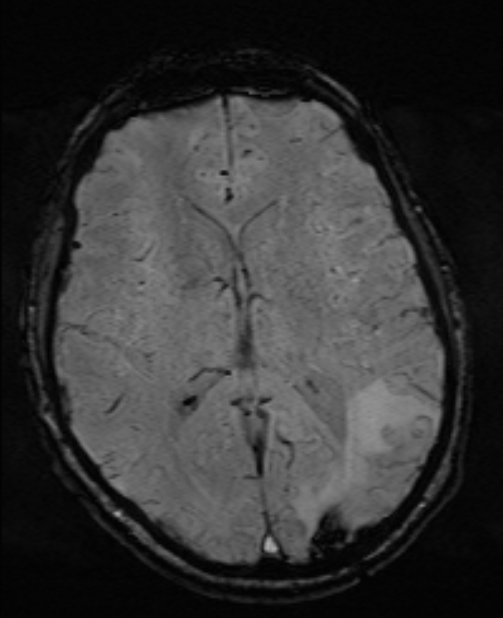 Brain metastases - lung cancer primary (Radiopaedia 75060-86115 Axial SWI 34).jpg