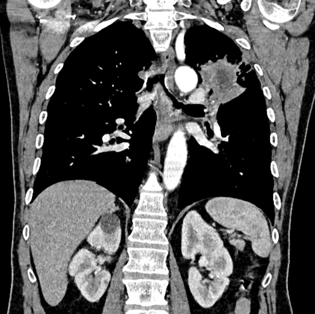 Brain metastases - lung cancer primary (Radiopaedia 75060-86116 C+ arterial phase 42).jpg
