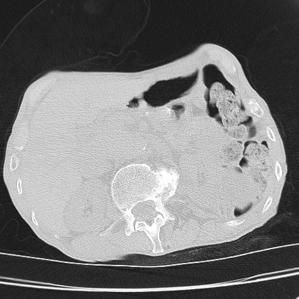 Brain metastases from lung cancer (Radiopaedia 27849-28093 Axial lung window 66).jpg