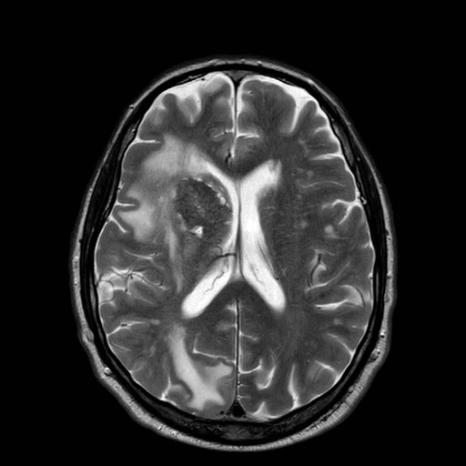 File:Brain metastases from lung cancer (Radiopaedia 83839-99028 Axial T2 21).jpg