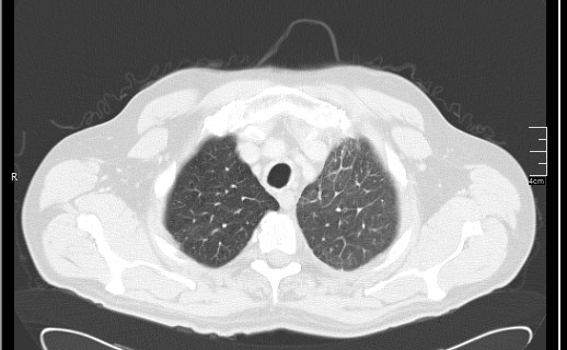 Brain metastases from squamocellular lung cancer (Radiopaedia 56515-63219 Axial lung window 16).jpg