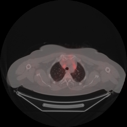 Brain metastasis (Radiopaedia 89847-106962 Axial lung window 9).jpg