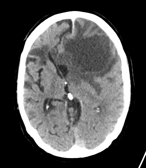 File:Brain metastasis (lung cancer) (Radiopaedia 48289-53177 Axial non-contrast 16).png