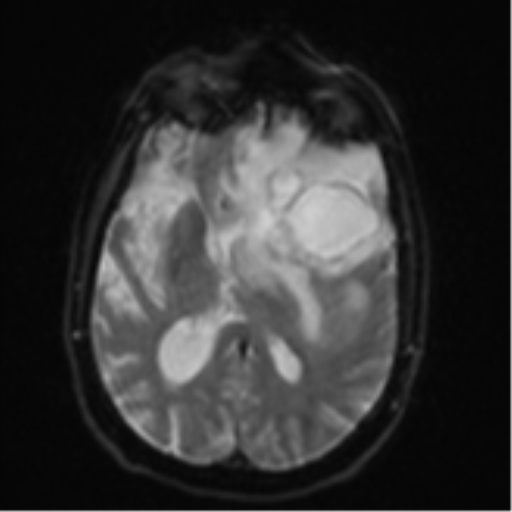 Brain metastasis (lung cancer) (Radiopaedia 48289-53179 Axial DWI 15).png