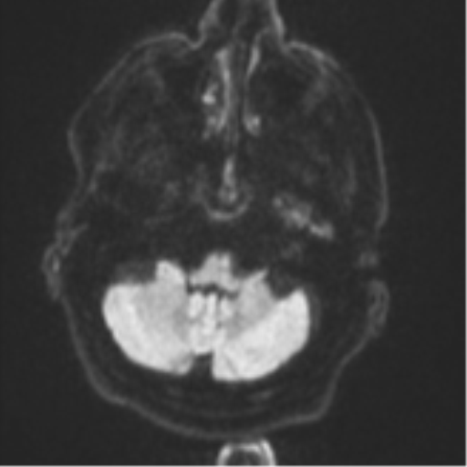 File:Brain metastasis (lung cancer) (Radiopaedia 48289-53179 Axial DWI 33).png