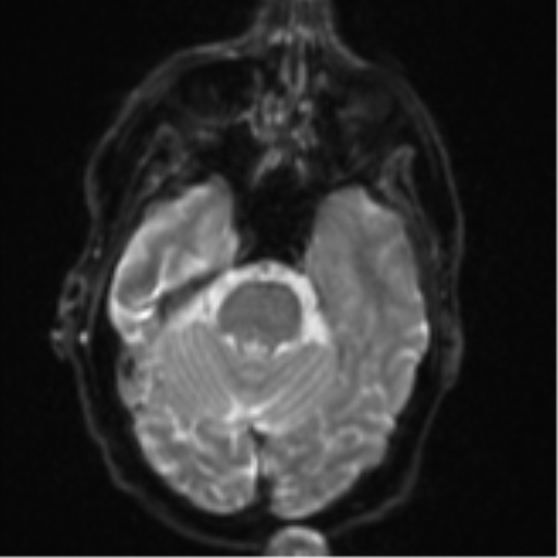 File:Brain metastasis (lung cancer) (Radiopaedia 48289-53179 Axial DWI 8).png