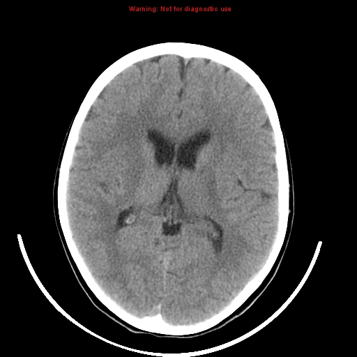 File:Brainstem glioma (Radiopaedia 9444-10123 non-contrast 13).jpg