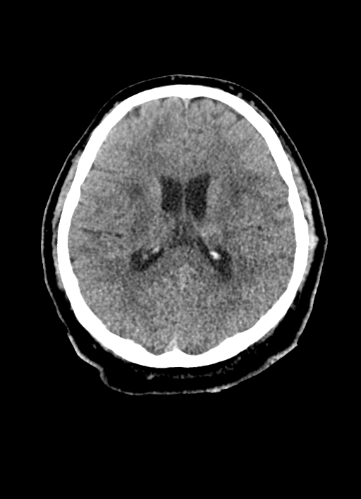 Brainstem hemorrhage (Radiopaedia 81294-94976 Axial non-contrast 28).jpg