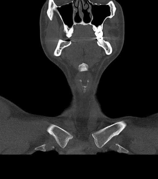 Branchial cleft cyst (Radiopaedia 31167-31875 Coronal bone window 21).jpg
