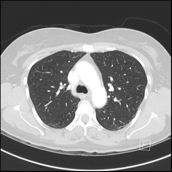Breast metastases from renal cell cancer (Radiopaedia 79220-92225 Axial lung window 29).jpg