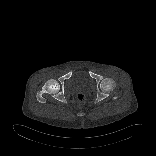 Brodie abscess- femoral neck (Radiopaedia 53862-59966 Axial bone window 157).jpg