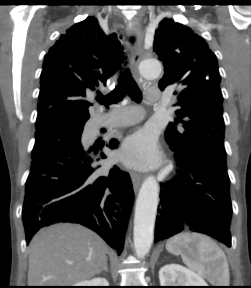 Bronchial artery aneurysms (Radiopaedia 42282-45385 Coronal C+ delayed 38).png