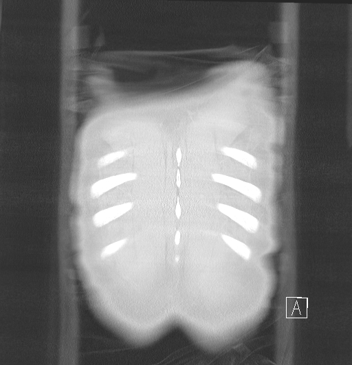 File:Bronchial atresia (Radiopaedia 73677-84470 Coronal lung window 35).jpg