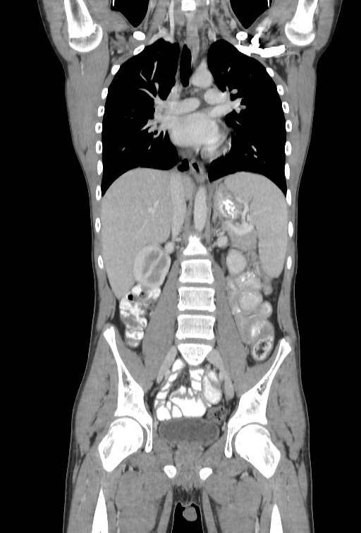 Bronchial carcinoid tumor (Radiopaedia 57187-64090 B 54).jpg