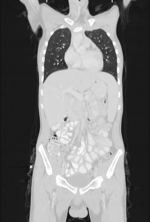 Bronchial carcinoid tumor (Radiopaedia 57187-64090 Coronal lung window 32).jpg