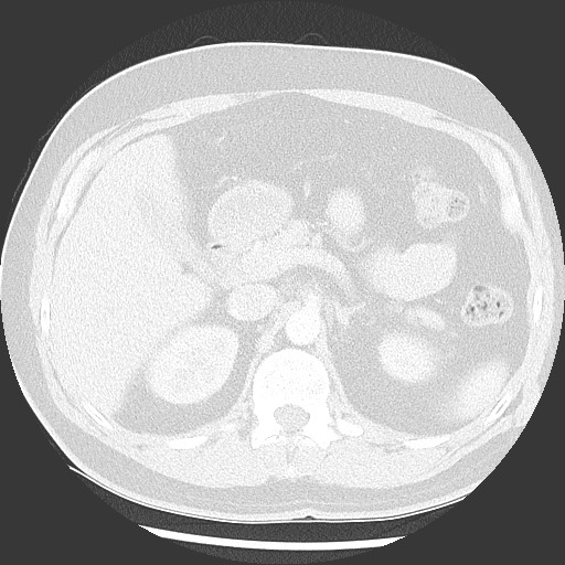 Bronchial carcinoid tumor (Radiopaedia 67377-76764 Axial lung window 66).jpg