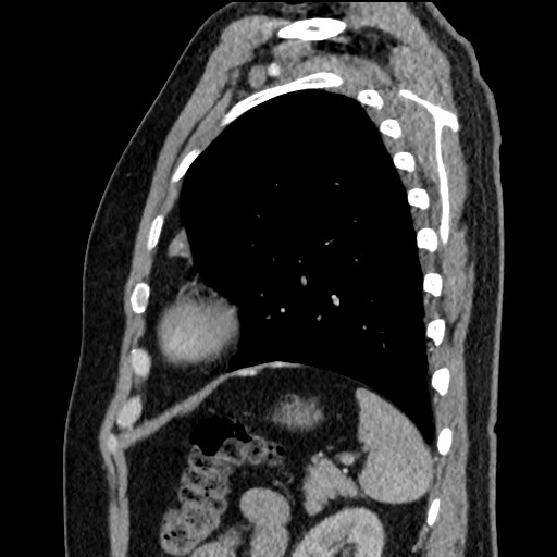 Bronchial carcinoid tumor (Radiopaedia 67377-76764 E 54).jpg