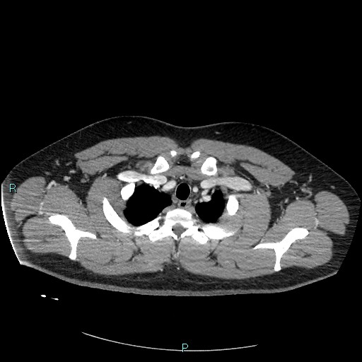 Bronchial carcinoid tumor (Radiopaedia 78272-90875 A 19).jpg
