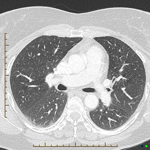 Bronchial diverticula (Radiopaedia 79512-92676 Axial lung window 82).jpg