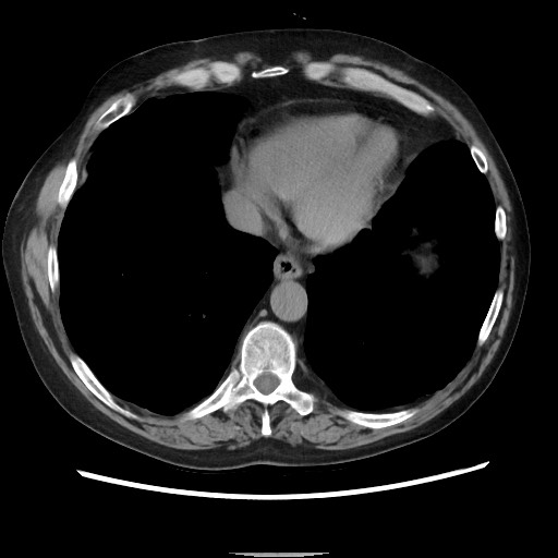 Bronchial stenosis - lung transplant (Radiopaedia 73133-83848 Axial non-contrast 47).jpg