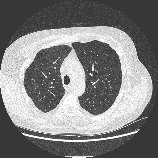 File:Bronchial stenosis - lung transplant (Radiopaedia 73133-83848 B 11).jpg