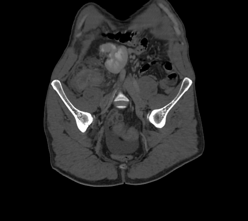 File:Bronchiectasis in Crohn disease (Radiopaedia 60311-67977 Coronal bone window 3).jpg