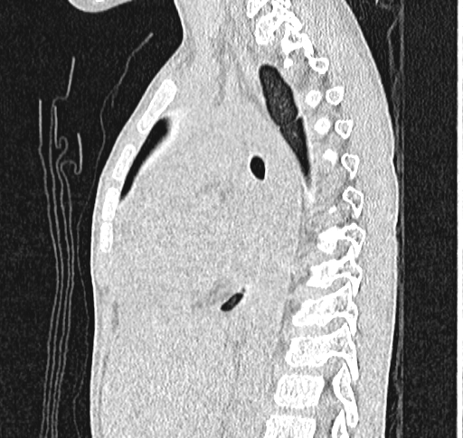 File:Bronchiolitis obliterans (Radiopaedia 71538-81897 Sagittal lung window 38).jpg