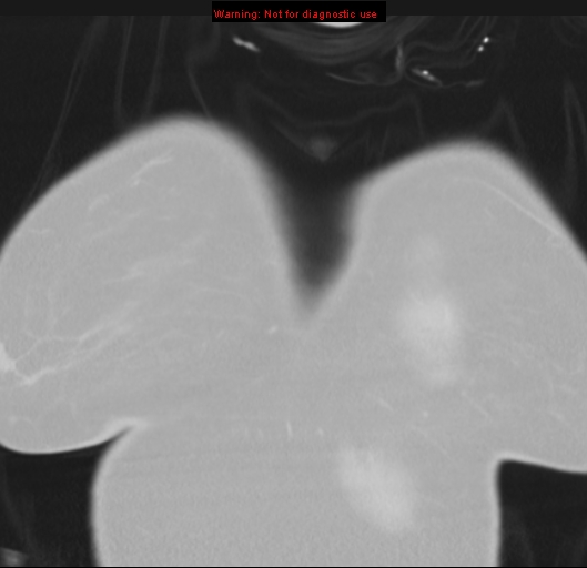 Bronchoalveolar carcinoma (BAC) (Radiopaedia 13436-13392 Coronal lung window 2).jpg
