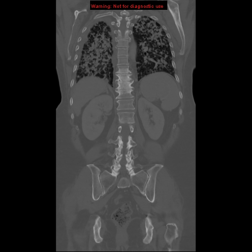 File:Bronchoalveolar carcinoma (Radiopaedia 13224-13233 Coronal non-contrast 19).jpg