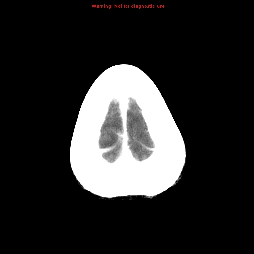 File:Bronchogenic carcinoma brain metastasis (Radiopaedia 9286-9970 B 27).jpg
