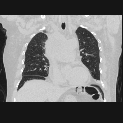 File:Bronchogenic carcinoma with metastatic lymphadenopathy (Radiopaedia 37671-39569 Coronal lung window 20).jpg