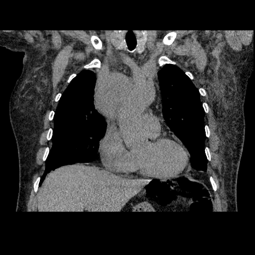 File:Bronchogenic carcinoma with metastatic lymphadenopathy (Radiopaedia 37671-39569 Coronal non-contrast 17).jpg